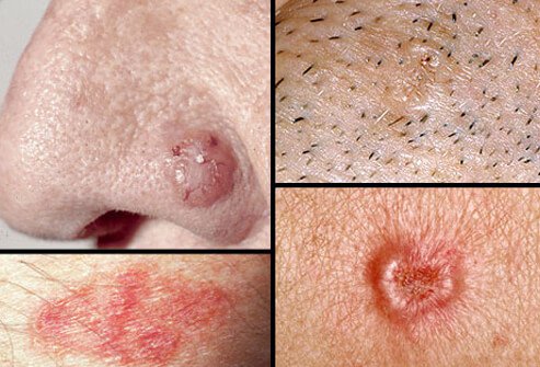 basal_cell_carcinoma.jpg