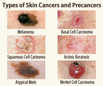 Difference Between Melanoma And Non Melanoma