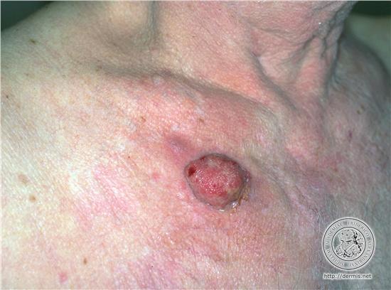 squamous cell carcinoma.jpg