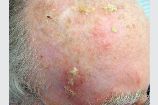 actinic keratosis scalp systems