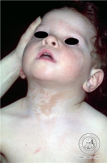 brown birthmarks