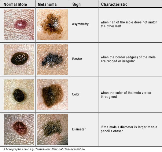 mole skin cancer