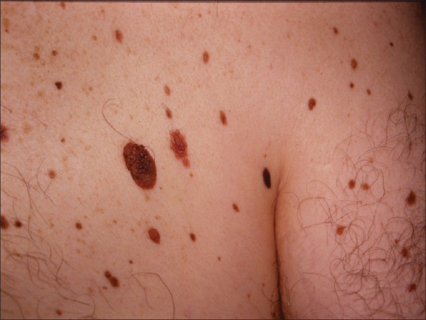 dysplastic nevus