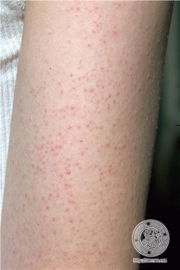 Keratosis Pilaris Condition, Treatments and Pictures for Children