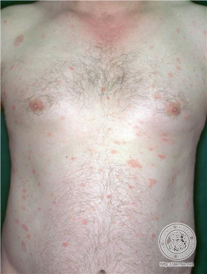 pityriasis rosea