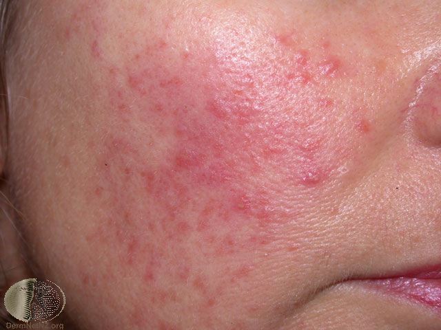 rosacea