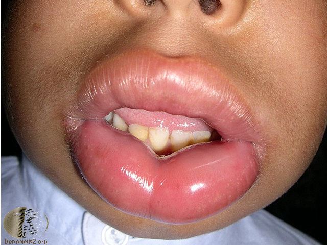 urticaria mouth