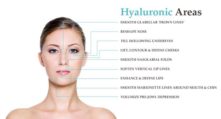 Hyaluronic acid fillers